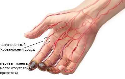 Причины гангрены руки