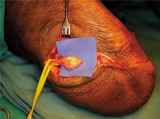 Удаление невромы культи