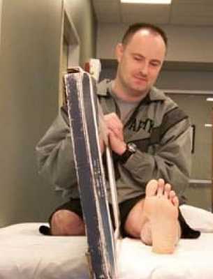 Зеркальная терапия при фантомной боли