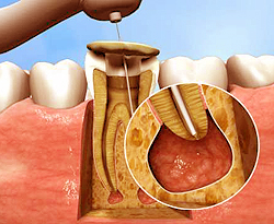 Лечение верхушечного периодонтита