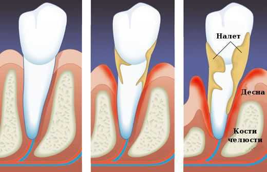 Налёт - причина парадонтоза