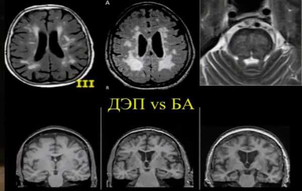 Дисциркуляторная энцефалопатия и болезнь Альцгеймера