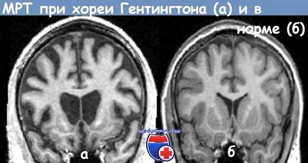 Хорея Гентингтона