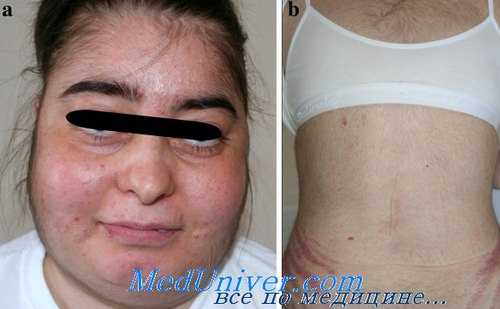 болезнь иценко-кушинга