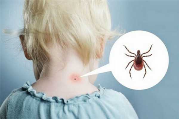 Болезнь Лайма - клещевой боррелиоз