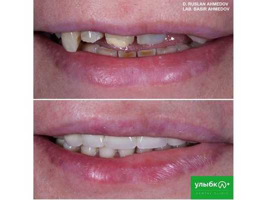 Протезирование фронтальной группы зубов, фото