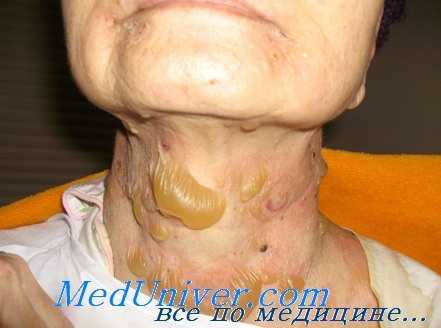 буллезный пемфигоид