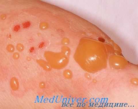 буллезный пемфигоид