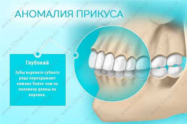 Глубокий прикус