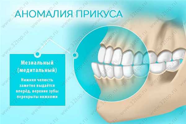 Мезиальный прикус