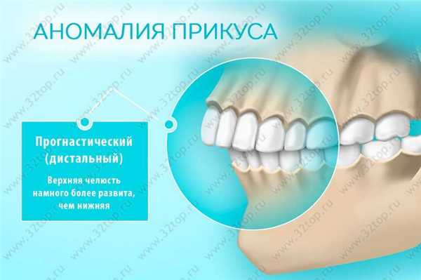 Дистальный прикус