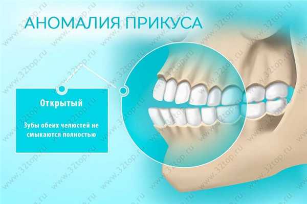 Открытый прикус