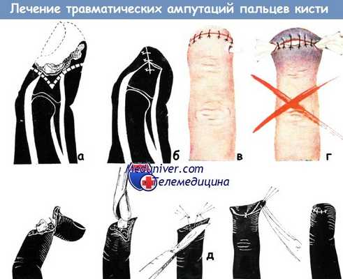 Лечение травматических ампутаций пальцев кисти