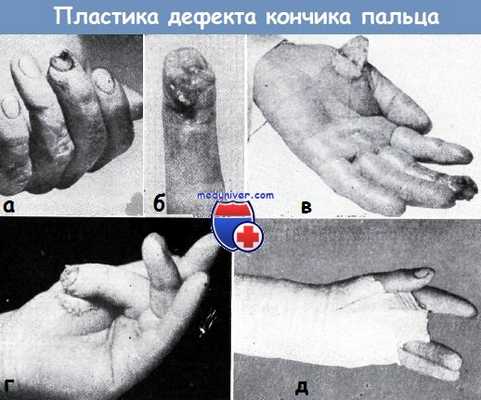 Пластика дефекта кончика пальца тенарным лоскутом