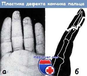Пластика дефекта кончика пальца