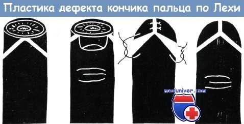 Пластика дефекта кончика пальца по Лехи