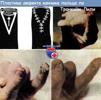 Пластика дефекта кончика пальца по Транкийи-Лили