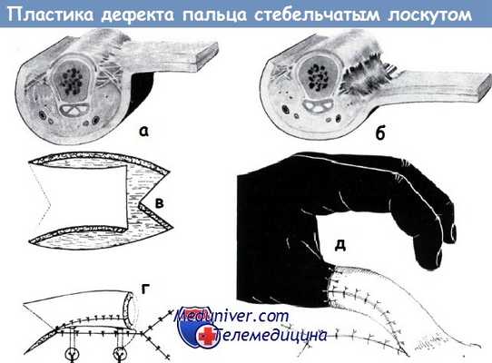 Пластика дефекта кончика пальца стебельчатым лоскутом