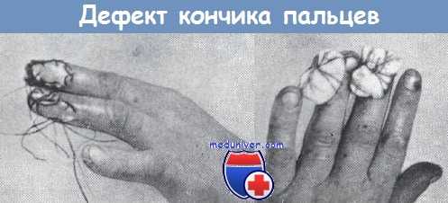 Дефекты кончика пальца
