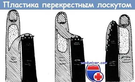 Пластика дефекта кончика пальца перекрестным лоскутом