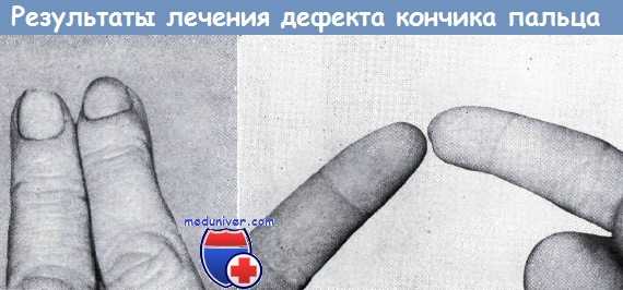 Дефекты кончика пальца