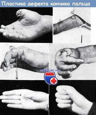 Пластика дефекта кончика пальца перекрестным лоскутом