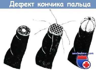 Дефекты кончика пальца