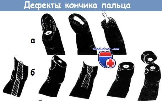 Дефекты кончика пальца