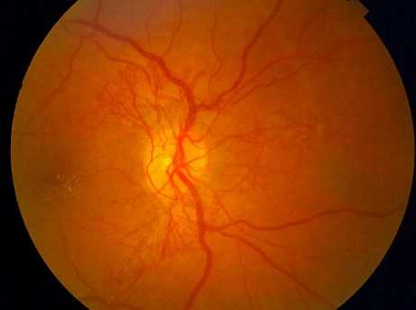 Диабетический макулярный отек