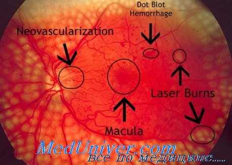диабетическая ретинопатия