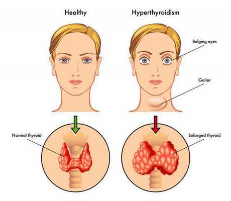 Базедова болезнь
