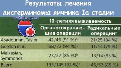 Прогноз и лечение дисгерминомы яичника Ia стадии