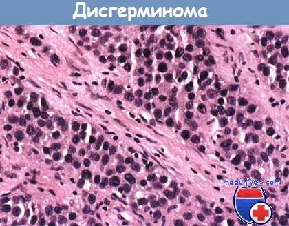 Дисгерминома