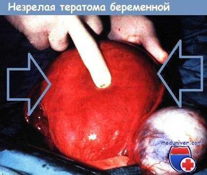 Незрелая тератома беременной