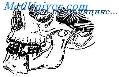 двусторонний перелом челюсти