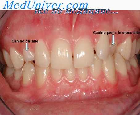 аппараты при пластике тканей