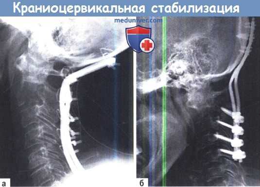 Краниоцервикальная стабилизация
