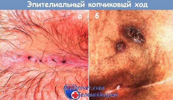 Эпителиальный копчиковый ход