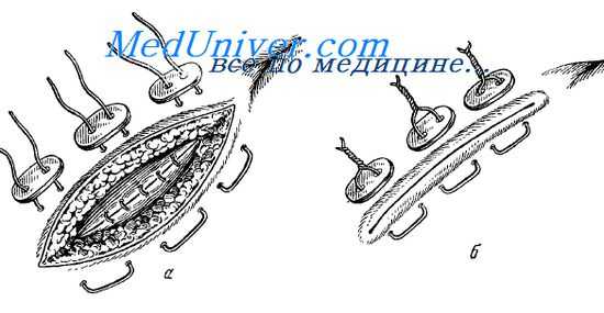 эпителиальные подкожные ходы