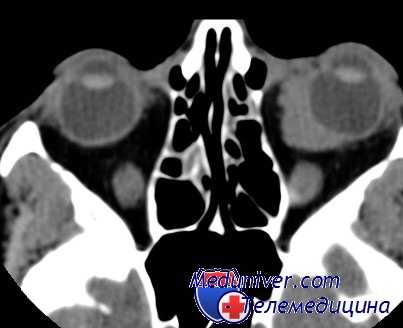 эхинококкоз глаз