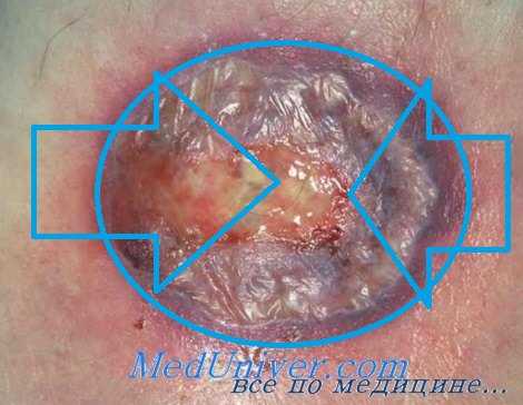 гангренозная пиодермия