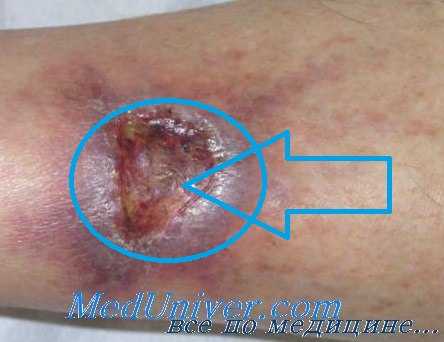 гангренозная пиодермия