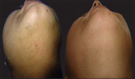 Сравнительное исследование лазеров для лечения гирсутизма