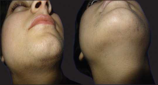 Сравнительное исследование лазеров для лечения гирсутизма