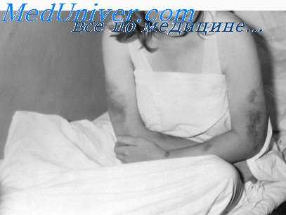 проявления глпс