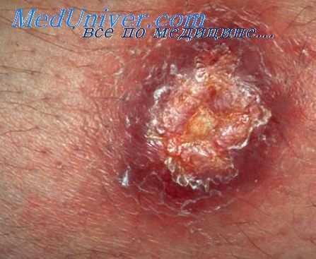 индийский лейшманиоз