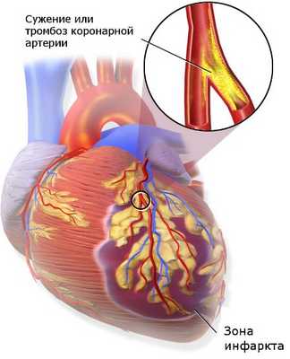 Блокирование кровотока в коронарной артерии приводит к гибели сердечной мышцы