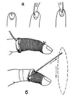 Инородные тела кисти