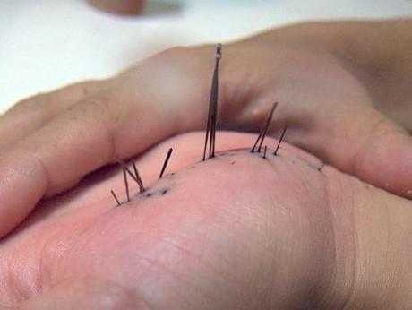 инородные тела в руке