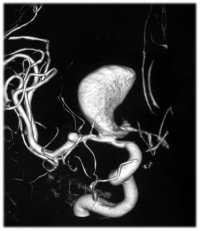 Множественные аневризмы. СКТ-Ангиография